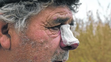 Es de Roca y hace cinco años espera que lo operen de un tumor en la nariz