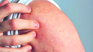 Dermatitis atópica: una app para poner en contacto a los pacientes