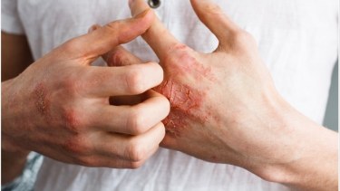 Enrojecimiento, ardor, picazón... y, sobre todo, inflamación. Tan común como molesto, es algo tratable.