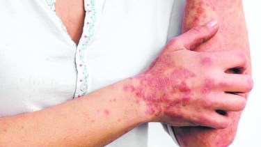 A las molestias propias de la enfermedad, a veces se suma que los pacientes en su día a día se enfrentan a la discriminación o al rechazo.