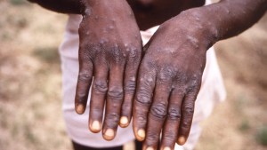 Viruela de mono: son ocho los países que registraron casos en los últimos días