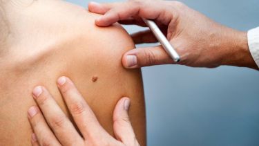 Es importante chequear con un médico nuestros lunares.