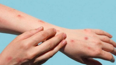 Viruela del mono: el Ministerio de Salud dijo que hay 170 casos detectados en el país
