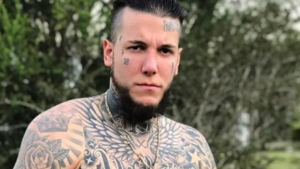 Alex Caniggia se operó la mandíbula y mostró los resultados en redes