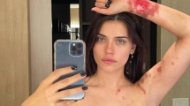 Imagen de Por primera vez, Eva De Dominici mostró fotos de las quemaduras que sufrió en la cocina de su casa