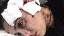 Imagen de El relato de la moza agredida salvajemente por dos hombres en Mendoza: «Me arruinaron la cara»