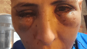 Podría perder la visión de un ojo tras ser atacada brutalmente a golpes en Vista Alegre