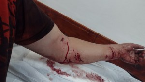 Brutal ataque de perros a una embarazada y a su pareja en Neuquén: «Mi nene de 5 años pudo esconderse»