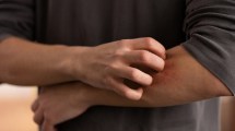 Imagen de ¿Sos un “imán de mosquitos”? Estas técnicas para ahuyentarlos pueden ser de ayuda
