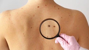 Llaman a evitar la excesiva exposición al sol para prevenir el cáncer de piel más agresivo.