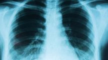 Imagen de Aprobaron en la Argentina un tratamiento para el cáncer de pulmón que evita la quimioterapia