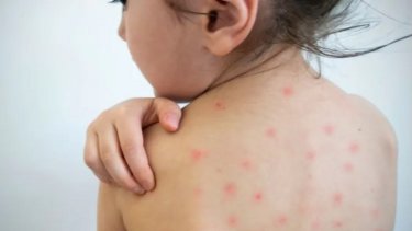 Qué es el sarampión, cómo se contagia y qué medidas se pueden tomar para prevenir la enfermedad