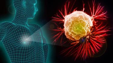El cáncer de mama es una enfermedad por la que se forman células malignas en los tejidos. Puede desarrollarse en hombres.