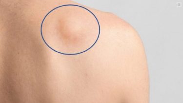 Sarcoma: un tumor que ataca los sostenes del cuerpo y no se puede prevenir