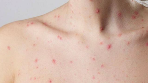 Viruela del mono en Neuquén y Río Negro: cómo se contagia, cuáles son los síntomas y qué hacer para prevenirla