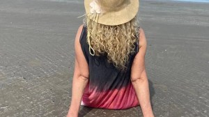 ¿Te quemaste mucho con el sol? Qué hay que hacer y qué no, y cuándo ir al médico
