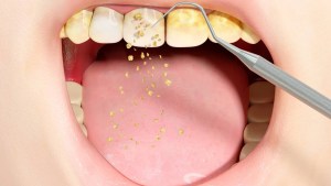 Un remedio natural ayuda a eliminar la placa dental y el sarro de los dientes muy rápido